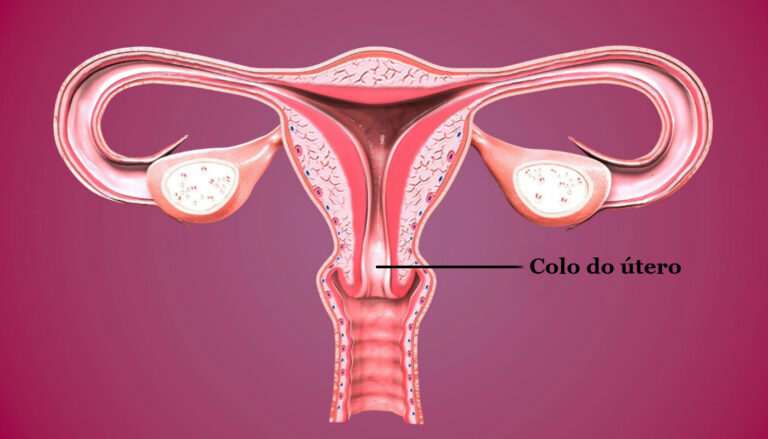 Misoprostol como colocar comprimido no colo do útero